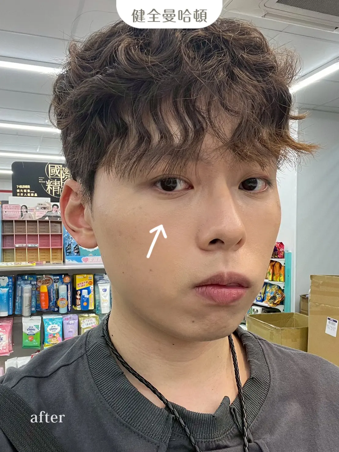 李沅勳 眼袋術後2