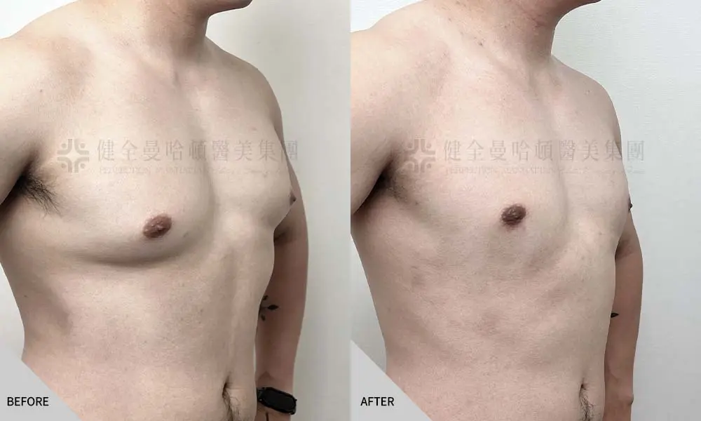 黃立維 男性女乳 02