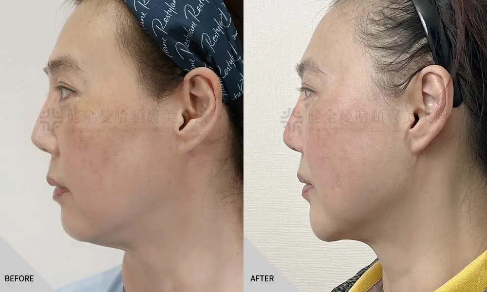 翁嘉妤 隆下巴天鵝頸 01