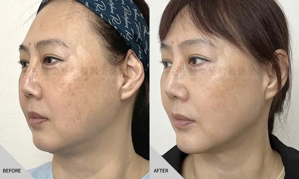 翁嘉妤 隆下巴天鵝頸 02