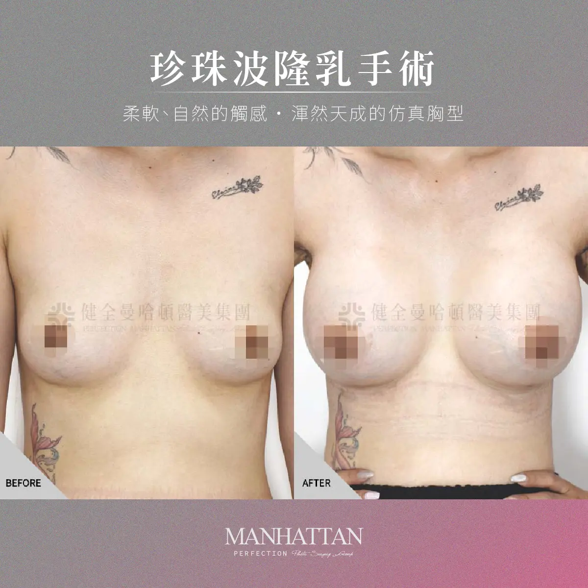 鄧儷婷 隆乳 1200x1200 02