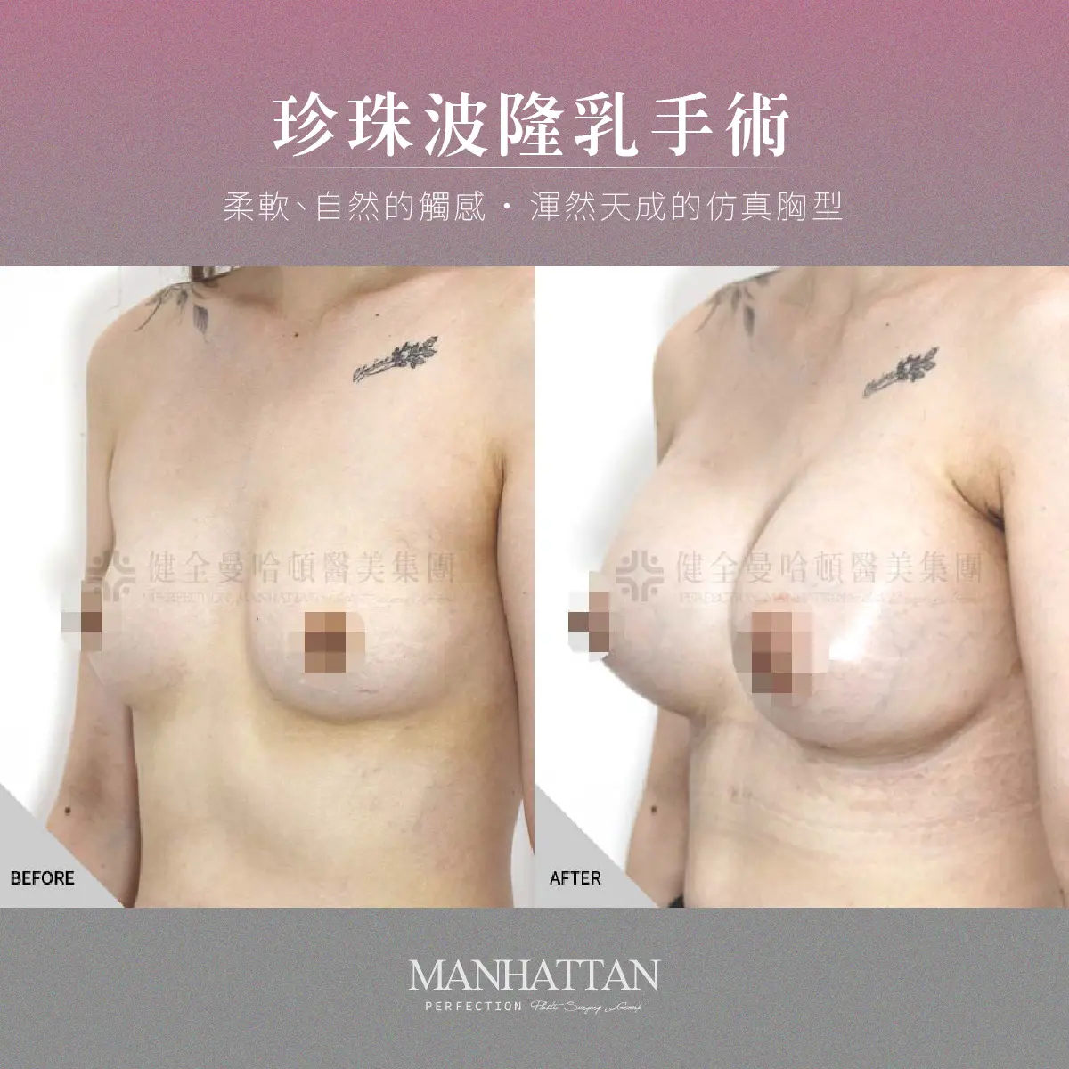 鄧儷婷 隆乳 1200x1200 03