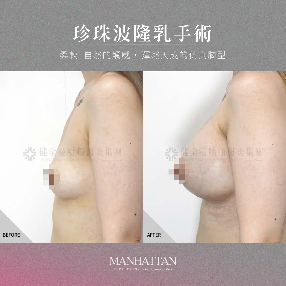 鄧儷婷 隆乳 1200x1200 04