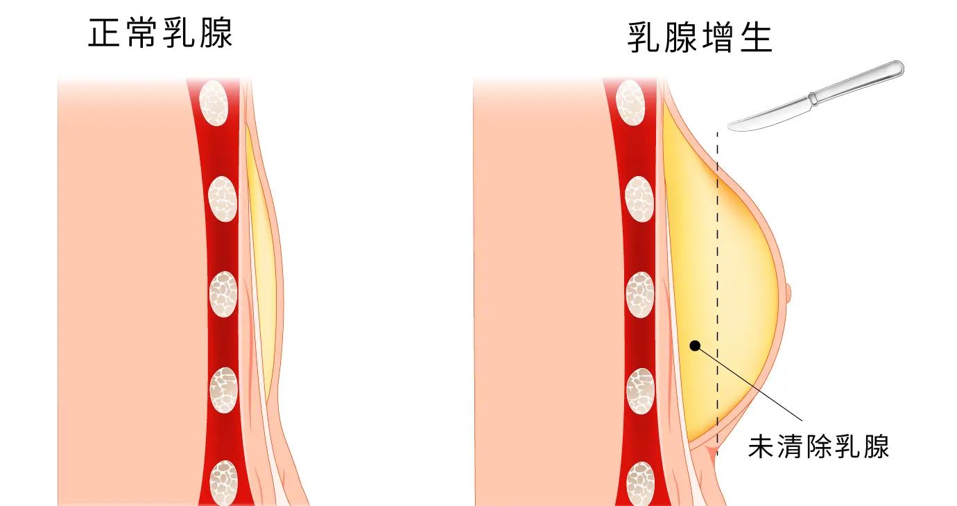 陳明芳 男乳問題 乳腺未清除 1