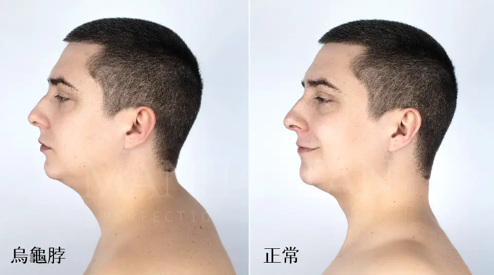 ALL 天鵝頸 烏龜脖