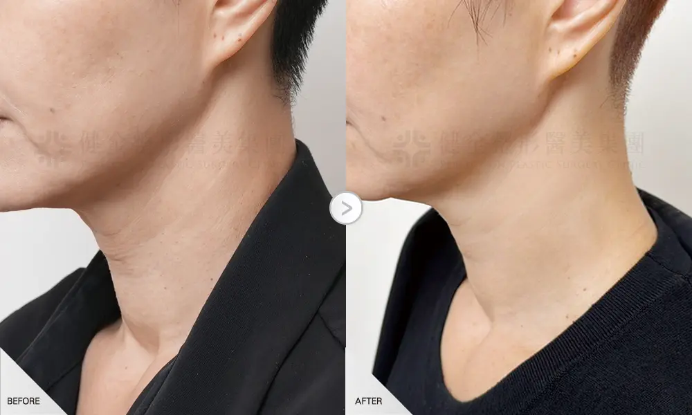 逆時針治療一次脖紋