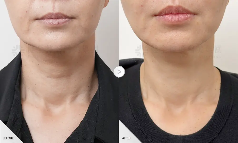 逆時針治療一次脖紋2