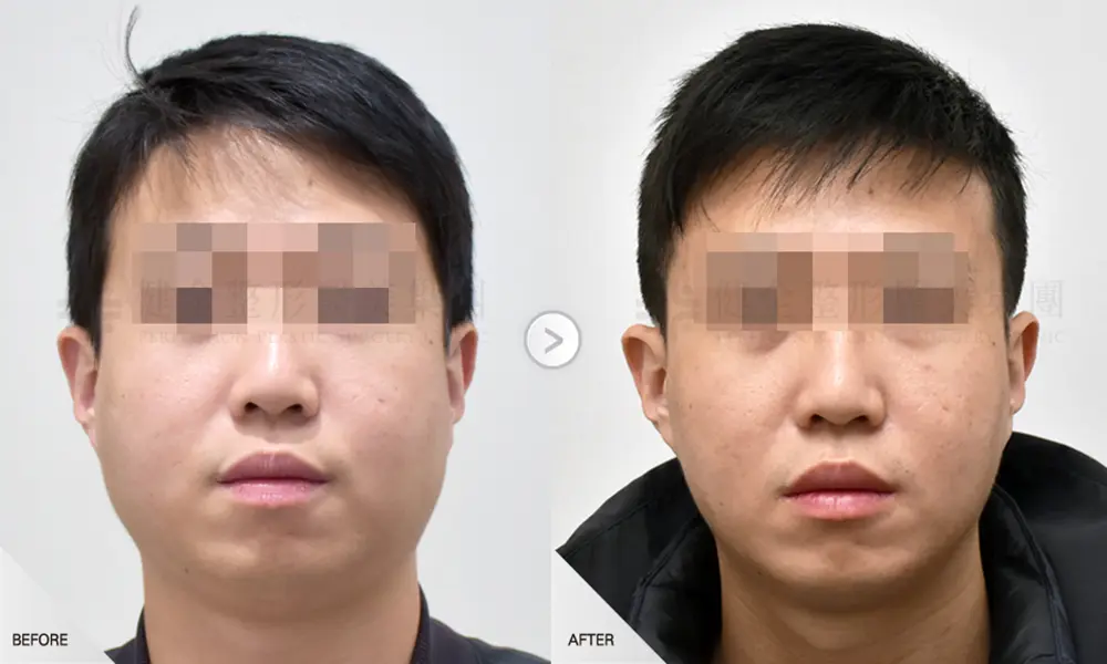 陳永富0511DR陳歷舜 消脂針肉毒BF 碼 1