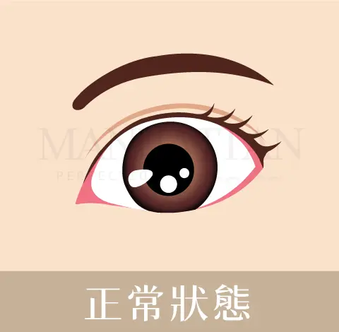 柯安達 雙眼皮 正常狀態