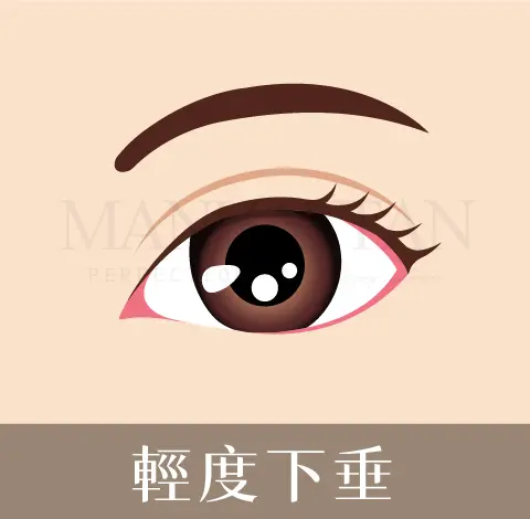 柯安達 雙眼皮 輕度下垂