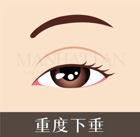 柯安達 雙眼皮 重度下垂