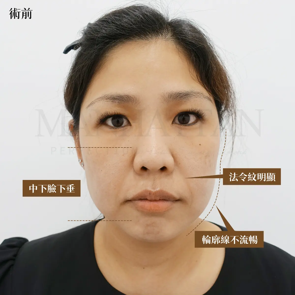 筋膜拉提 術前 3