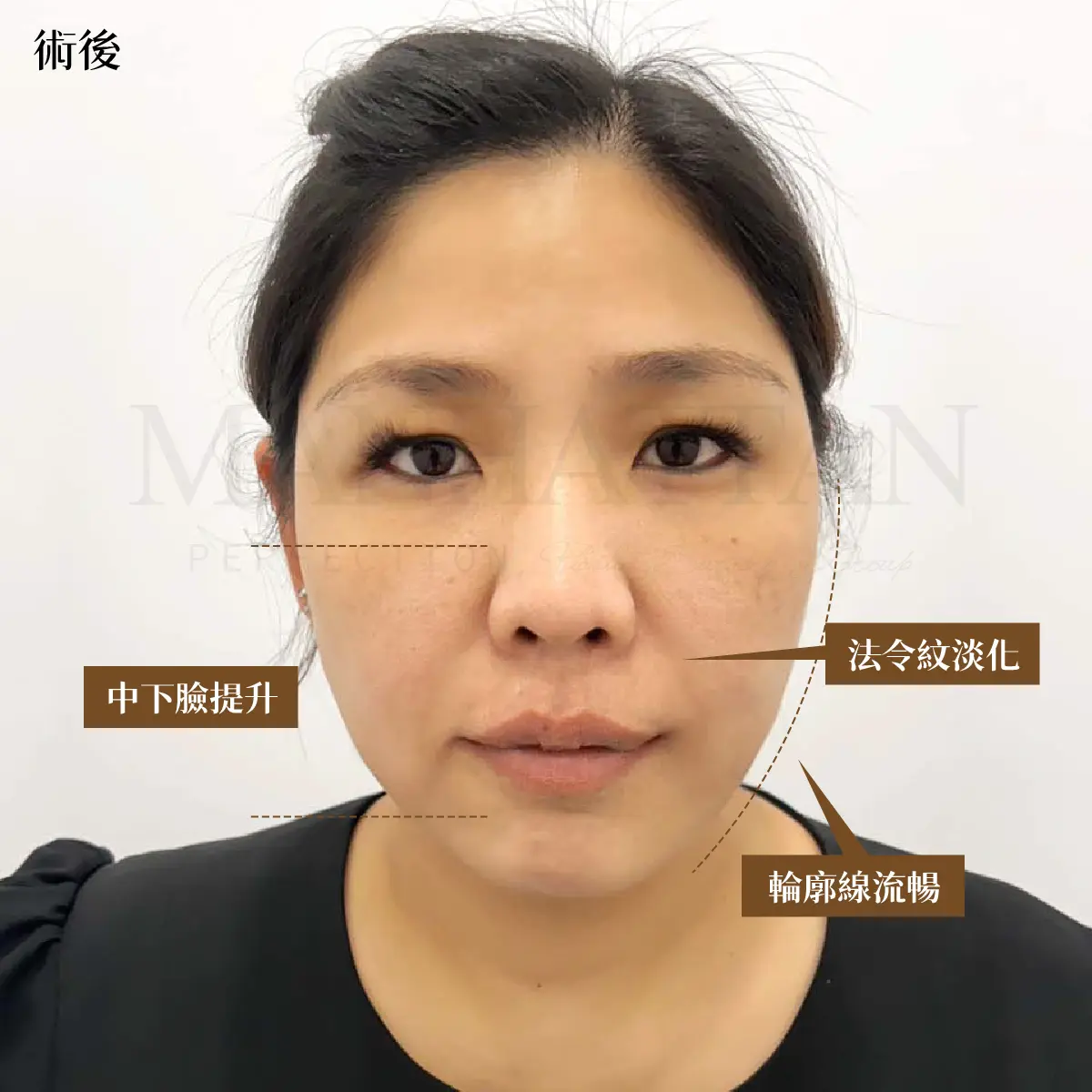 筋膜拉提 術後 3