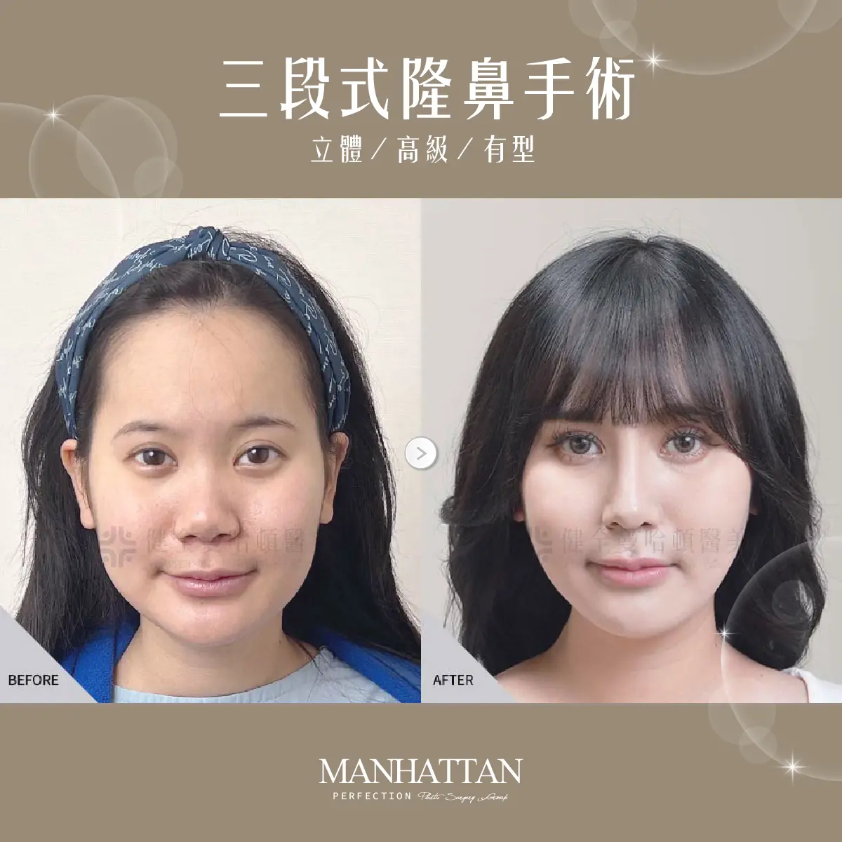 張瓅勻 隆鼻 02 複本 2