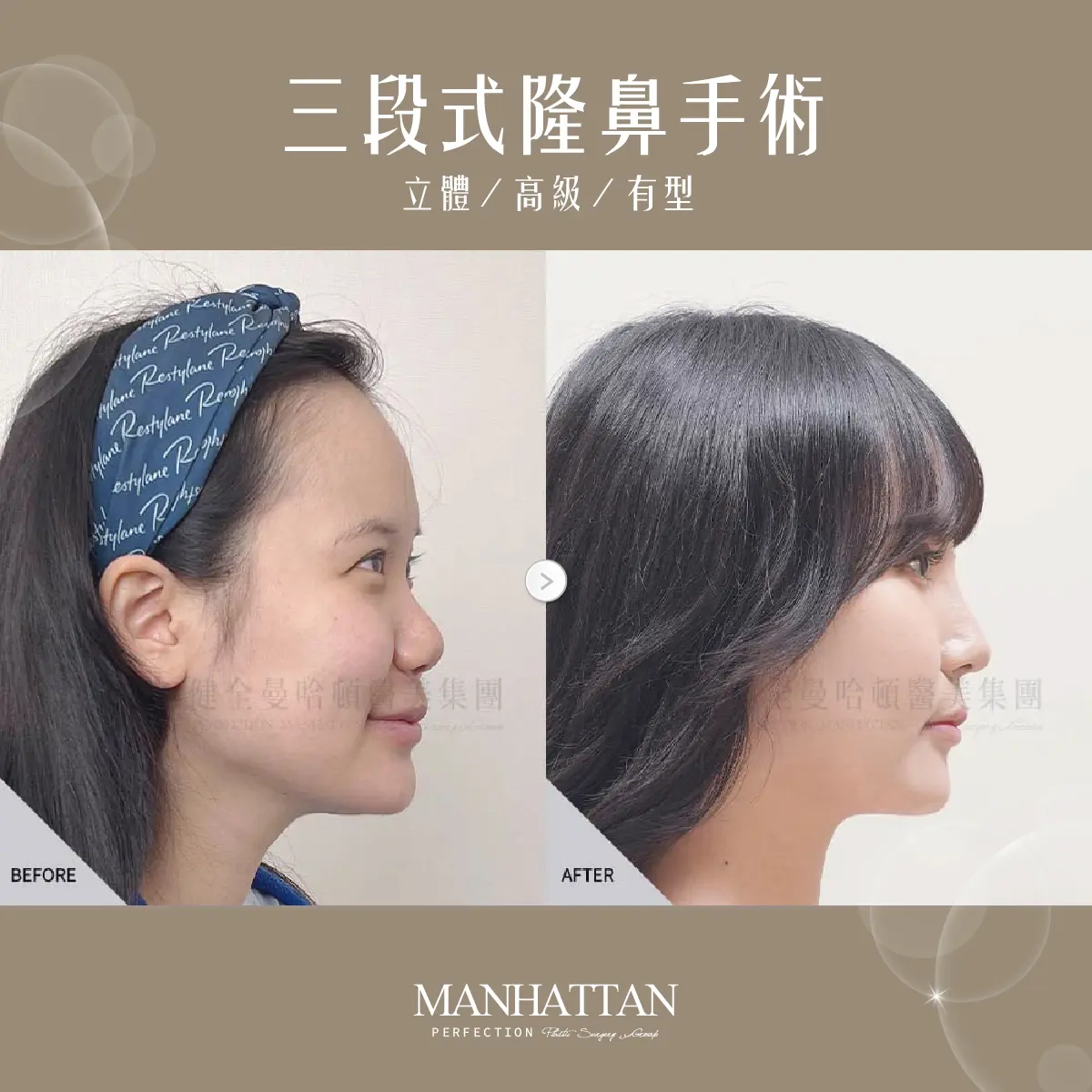 張瓅勻 隆鼻 02 複本 3